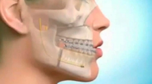 Prognatismo Mandibular