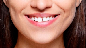 Diastema: O que é e como tratar?