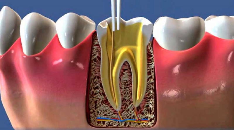 Quando é Necessário o Tratamento de Canal?
