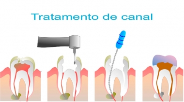 O que é tratamento Endodôntico?